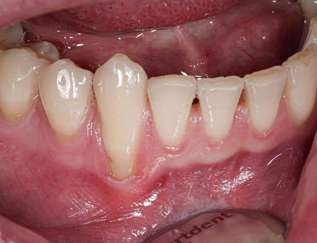 Zahnfleischrückgang 1
