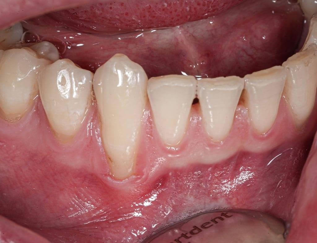 Treatment of dental trauma 1