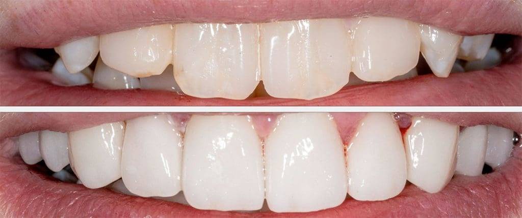 Veneers 24