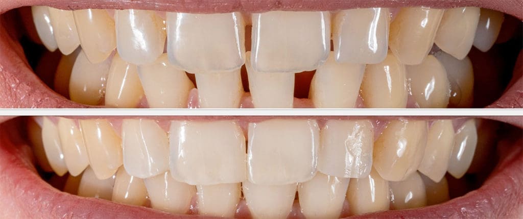 Veneers 14